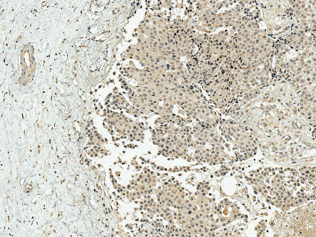 <p>Immunohistochemistry analysis using Rabbit Anti-CBP Polyclonal Antibody (SPC-752). Tissue: Breast Cancer. Species: Human. Fixation: Formalin Fixed Paraffin-Embedded. Primary Antibody: Rabbit Anti-CBP Polyclonal Antibody (SPC-752) at 1:50 for 30 min at RT. Counterstain: Hematoxylin. Magnification: 10X. HRP-DAB Detection.</p>
