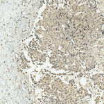 SPC-752_CBP_Antibody_IHC_Human_Breast-Cancer_10X_1.png