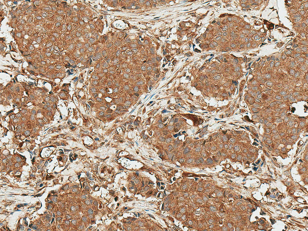 <p>Immunohistochemistry analysis using Rabbit Anti-ROR1 Polyclonal Antibody (SPC-762). Tissue: Breast Cancer. Species: Human. Fixation: Formalin Fixed Paraffin-Embedded. Primary Antibody: Rabbit Anti-ROR1 Polyclonal Antibody (SPC-762) at 1:50 for 30 min at RT. Counterstain: Hematoxylin. Magnification: 20X. HRP-DAB Detection.</p>
