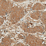 SPC-762_ROR1_Antibody_IHC_Human_Breast-Cancer_20X_1.png