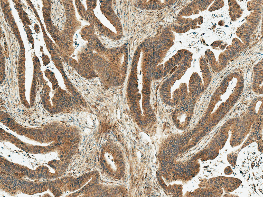 <p>Immunohistochemistry analysis using Rabbit Anti-MDM2 Polyclonal Antibody (SPC-778). Tissue: Stomach Cancer. Species: Human. Fixation: Formalin Fixed Paraffin-Embedded. Primary Antibody: Rabbit Anti-MDM2 Polyclonal Antibody (SPC-778) at 1:50 for 30 min at RT. Counterstain: Hematoxylin. Magnification: 10X. HRP-DAB Detection.</p>
