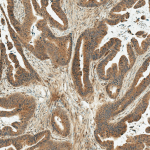 SPC-778_MDM2_Antibody_IHC_Human_Stomach-Cancer_10X_1.png