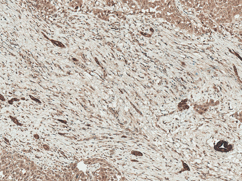 <p>Immunohistochemistry analysis using Rabbit Anti-LRP1 Polyclonal Antibody (SPC-785). Tissue: Liver. Species: Human. Fixation: Formalin Fixed Paraffin-Embedded. Primary Antibody: Rabbit Anti-LRP1 Polyclonal Antibody (SPC-785) at 1:50 for 30 min at RT. Counterstain: Hematoxylin. Magnification: 10X. HRP-DAB Detection.</p>
