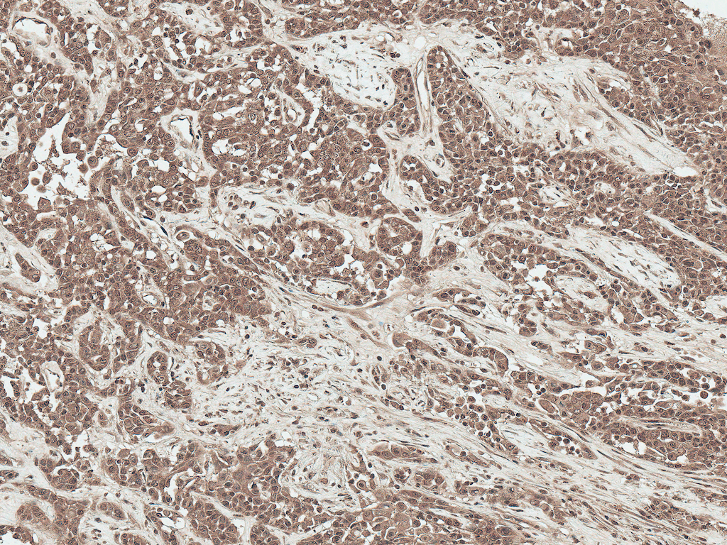 <p>Immunohistochemistry analysis using Rabbit Anti-SFRP2 Polyclonal Antibody (SPC-786). Tissue: Liver. Species: Human. Fixation: Formalin Fixed Paraffin-Embedded. Primary Antibody: Rabbit Anti-SFRP2 Polyclonal Antibody (SPC-786) at 1:50 for 30 min at RT. Counterstain: Hematoxylin. Magnification: 20X. HRP-DAB Detection.</p>
