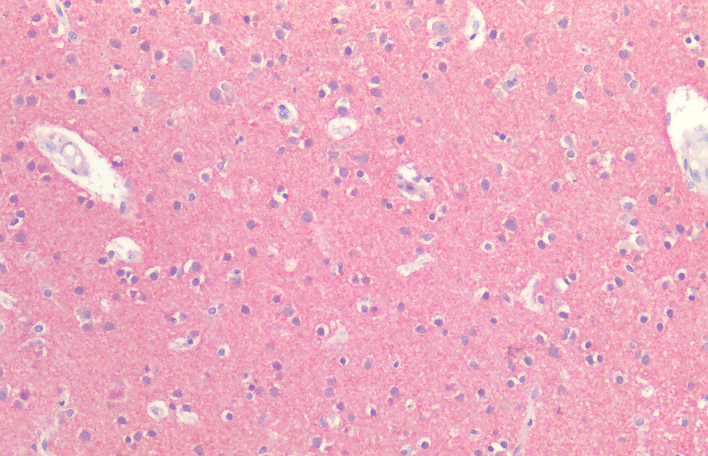 <p>Immunohistochemistry analysis using Rabbit Anti-Tau Polyclonal Antibody (SPC-802). Tissue: Brain Cortex. Species: Human. Fixation: Formalin fixed paraffin-embedded. Primary Antibody: Rabbit Anti-Tau Polyclonal Antibody (SPC-802).</p>
