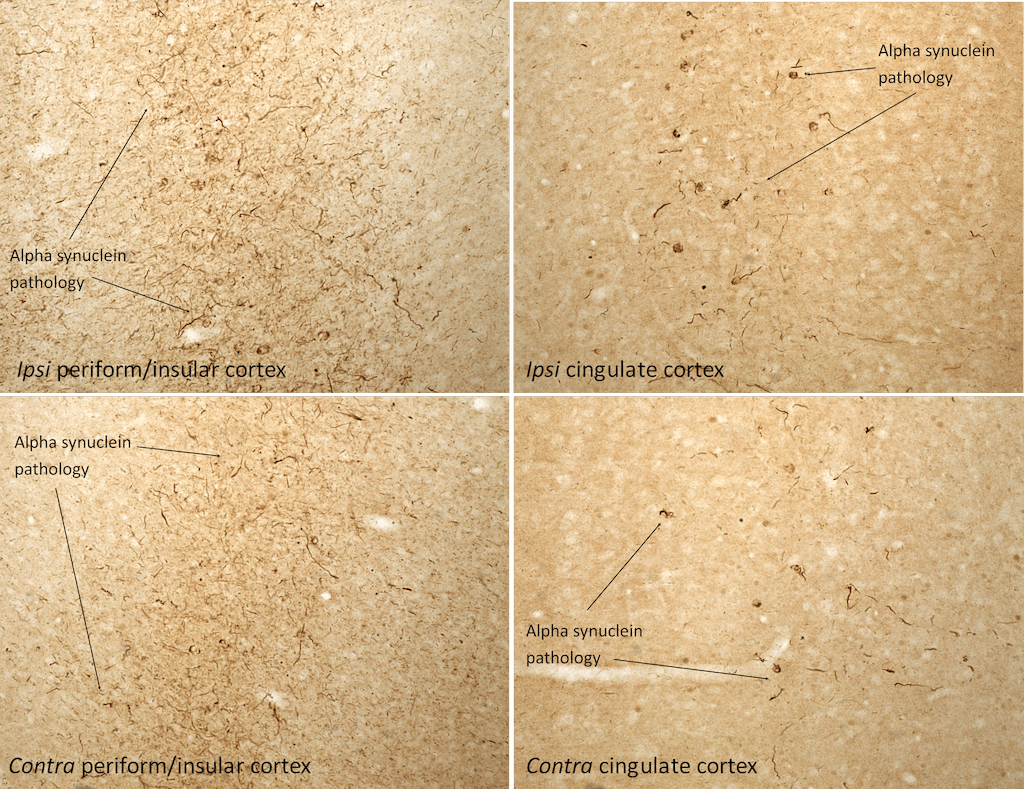 IHC of Sprague-Dawley rat brain injected with Type 1 mouse alpha synuclein preformed fibrils (SPR-324)