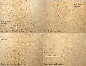 IHC of Sprague-Dawley rat brain injected with Type 1 mouse alpha synuclein Pre-formed Fibrils (SPR-324)