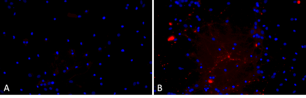 <p>Primary rat hippocampal neurons show lewy body inclusion formation when treated with A53T mutant Alpha Synuclein Protein Pre-formed Fibrils (SPR-326) (B) but not when treated with a media control (A). Tissue: Primary hippocampal neurons. Species: Sprague-Dawley rat. Primary Antibody: Rabbit anti-pSer129 Antibody. Fibrils were diluted to 1 ug/uL in neuronal media consisting of B27, Glutamax, penicillin/strip, and neurobasalA and sonicated for 1 hour in a water bath. The sonicated stock was then used to achieve the final concentration of 1 ug/mL in the wells.</p>
