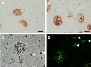 Four images of immunohistochemistry of amyloid plaques in AD-affected tissues.